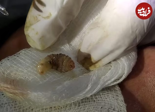 عجیب‌ ترین انگل‌ هایی که در بدن انسان پیدا شدند