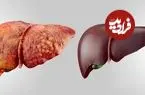 مهمترین نکات برای پیشگیری از کبد چرب