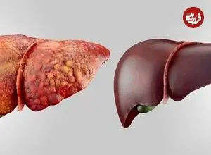 مهمترین نکات برای پیشگیری از کبد چرب