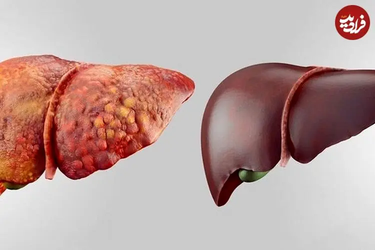 مهمترین نکات برای پیشگیری از کبد چرب