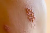 زونا چیست و چه علائم و عوارضی دارد؟