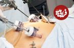 چگونه می‌توان توده‌های بدخیم را در جراحی لاپاراسکوپی به صورت ایمن خارج کرد؟