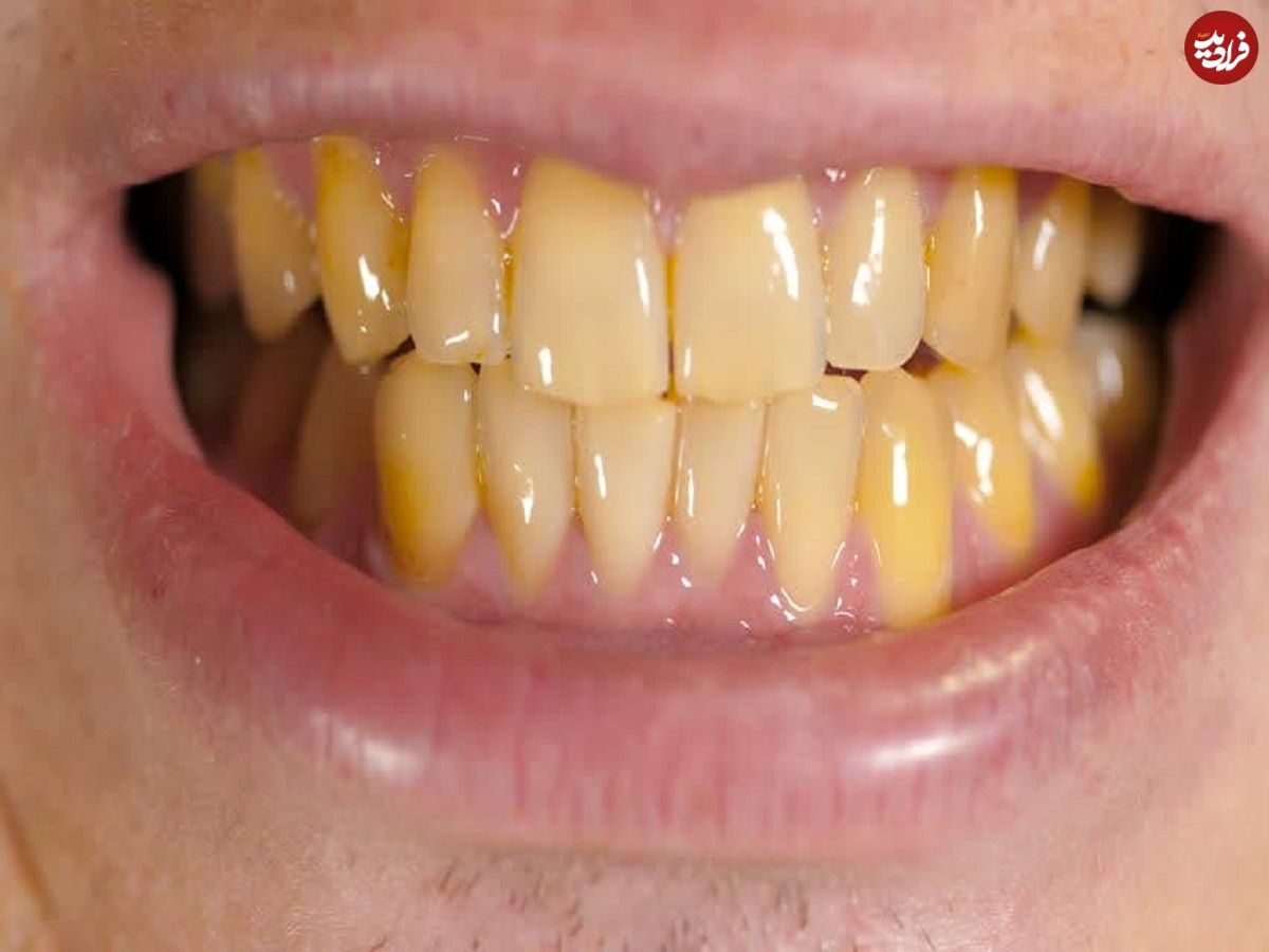 6 عادت غلط، دندان‌های شما را زرد می‌کند