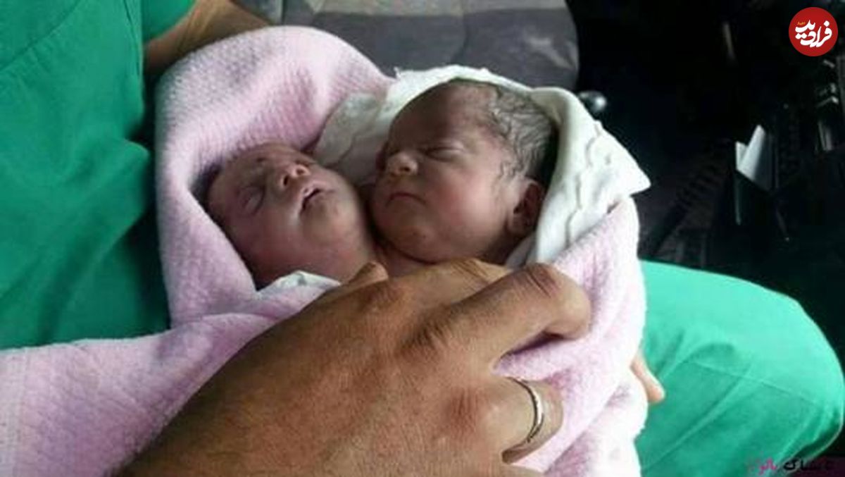 عکس/ تولد نوزاد دو سر در سوریه
