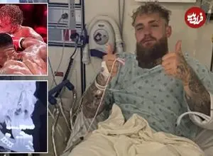 عکس؛ ژست میلیونی جیک پاول پس از شکست سنگین در برابر آنتونی جاشوا و جراحی فک