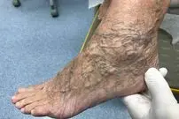 واریس چیست و چه کسانی بیشتر به آن مبتلا می‌شوند؟