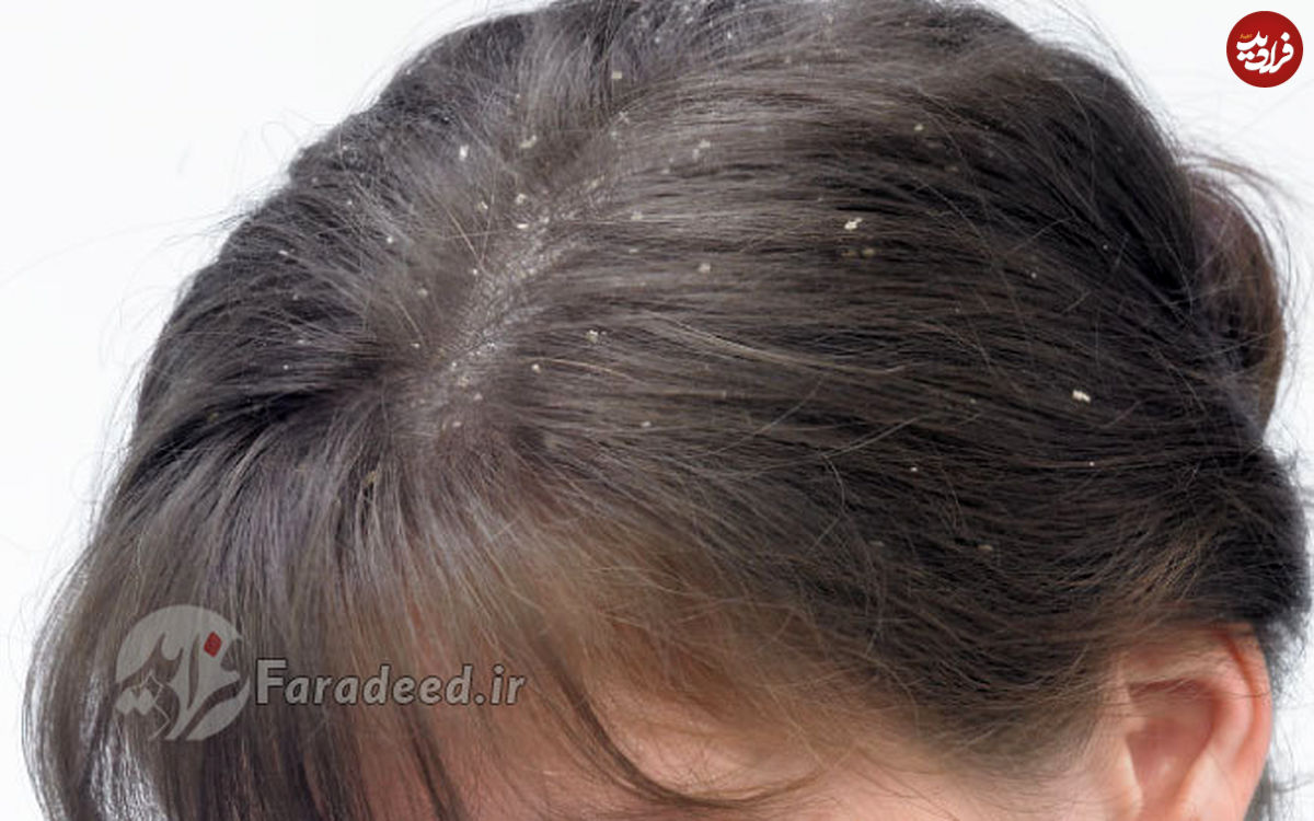 11 درمان طبیعی برای شوره مو