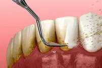 ببینید؛ طبیعی‌ترین جرم گیر فوری دندان؛ سیاه ولیک؛ بهترین جرم گیر دندان خانگی را بشناسید