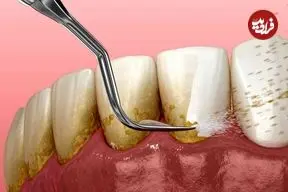 ببینید؛ طبیعی‌ترین جرم گیر فوری دندان؛ سیاه ولیک؛ بهترین جرم گیر دندان خانگی را بشناسید