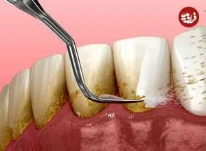 ببینید؛ طبیعی‌ترین جرم گیر فوری دندان؛ سیاه ولیک؛ بهترین جرم گیر دندان خانگی را بشناسید