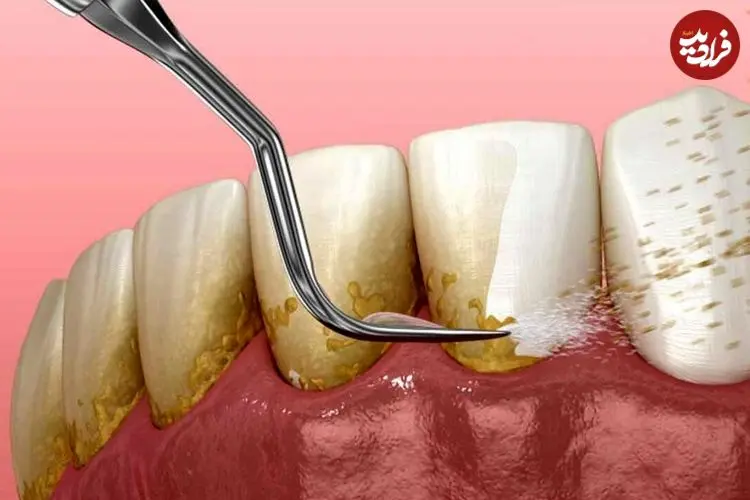 ببینید؛ طبیعی‌ترین جرم گیر فوری دندان؛ سیاه ولیک؛ بهترین جرم گیر دندان خانگی را بشناسید