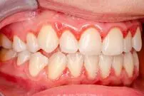 مهمترین بیماری‌های لثه؛ چه باید کرد؟