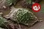 چرا «سرطان‌های زودرس» در جهان شیوع بیشتری پیدا کرده‌اند؟