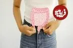 ابتلا به سرطان روده بزرگ با ویروسی که درون باکتری‌ها پنهان شده است!