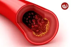 بهترین درمان‌های خانگی برای «چربی خون بالا» 