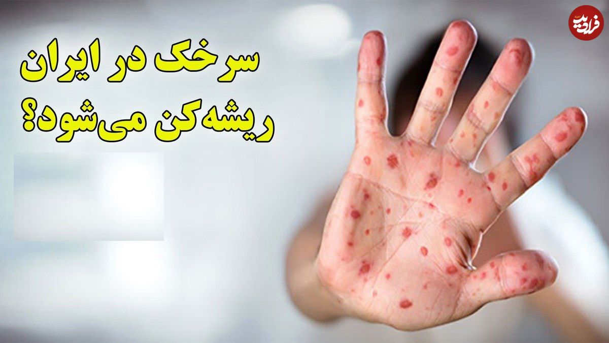 ببینید؛ ریشه‌کنی سرخک در ایران در معرض خطر؛ افزایش موارد ابتلا در جهان