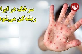 ببینید؛ ریشه‌کنی سرخک در ایران در معرض خطر؛ افزایش موارد ابتلا در جهان