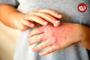 علت تشدید اگزما در نتیجه استرس کشف شد