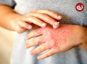 علت تشدید اگزما در نتیجه استرس کشف شد