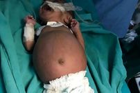 عکس؛ اتفاقی نادر در هند؛ تولد نوزادی که در شکمش جنین دوقلوی خود را داشت