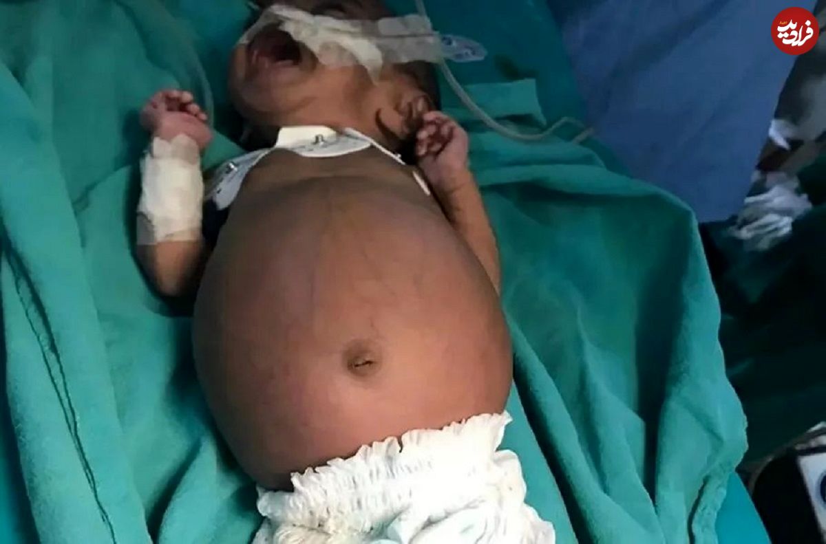 عکس؛ اتفاقی نادر در هند؛ تولد نوزادی که در شکمش جنین دوقلوی خود را داشت