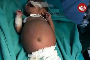 عکس؛ اتفاقی نادر در هند؛ تولد نوزادی که در شکمش جنین دوقلوی خود را داشت