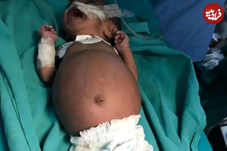 عکس؛ اتفاقی نادر در هند؛ تولد نوزادی که در شکمش جنین دوقلوی خود را داشت