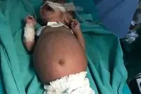 عکس؛ اتفاقی نادر در هند؛ تولد نوزادی که در شکمش جنین دوقلوی خود را داشت