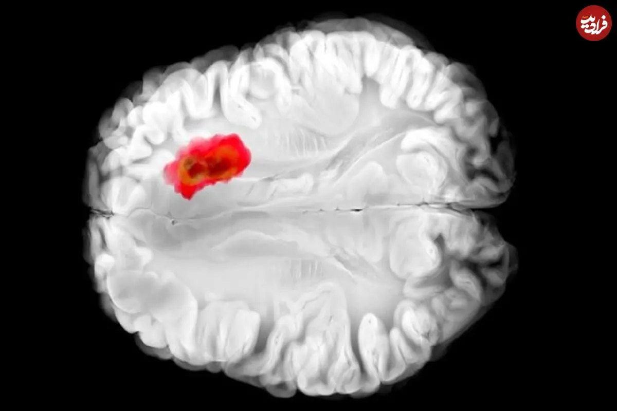 کشف دارویی برای مبارزه با کشنده‌ترین سرطان‌های مغز
