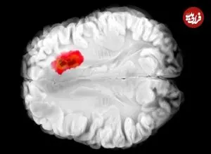 کشف دارویی برای مبارزه با کشنده‌ترین سرطان‌های مغز