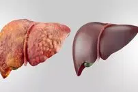 ۵ علامت مشکلات کبدی در ظاهر افراد
