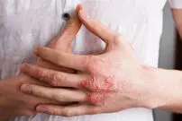 تغذیه بر درمان اگزما اثر دارد؟