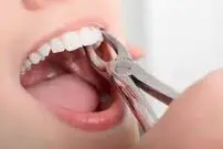 پنج خوراکی مناسب پس از کشیدن دندان