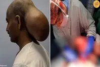 (تصاویر) ماجرای خارج کردن غده‌ای به بزرگی طالبی از سر یک مرد