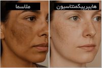 آیا ضد افتاب لک را از بین میبرد؟