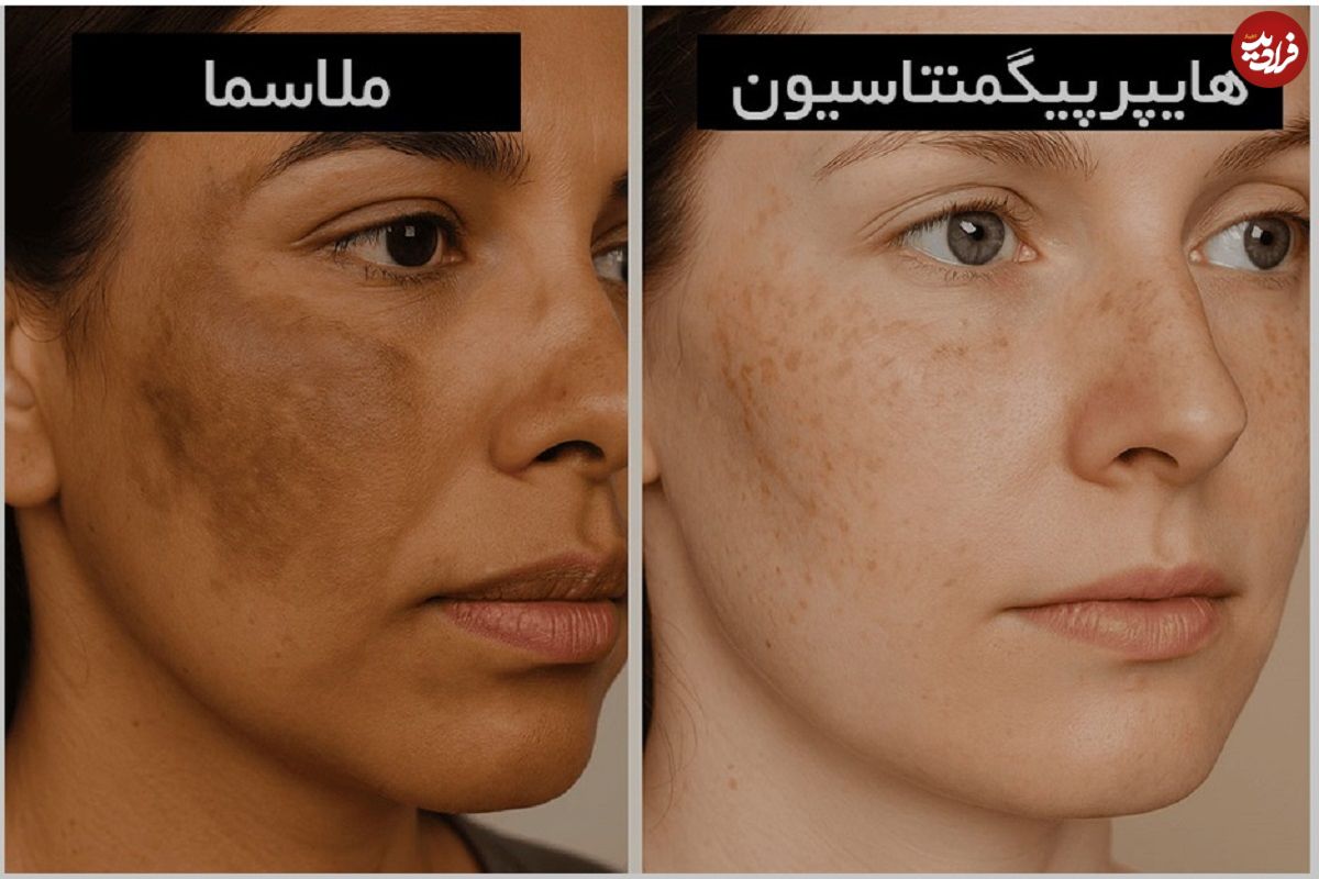 آیا ضد افتاب لک را از بین میبرد؟