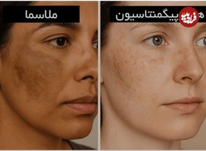 آیا ضد افتاب لک را از بین میبرد؟