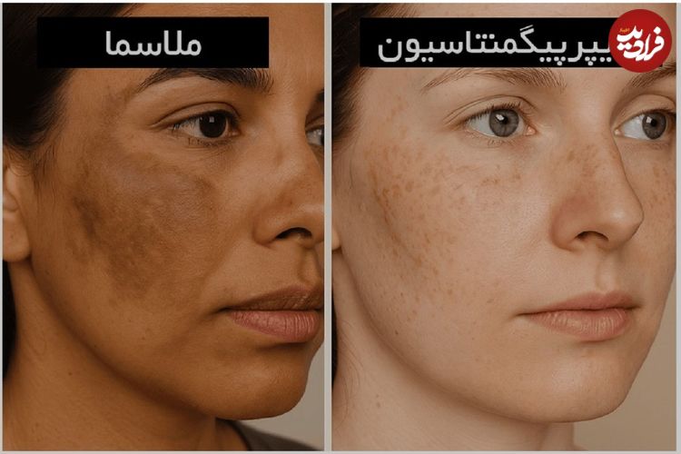 آیا ضد افتاب لک را از بین میبرد؟