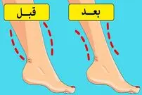 علت چاقی مچ پا چیست و چطور می توان آن را برطرف کرد؟