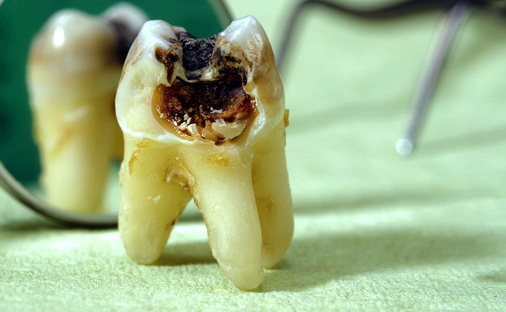 آیا پوسیدگی دندان، خطری برای قلب محسوب می شود؟