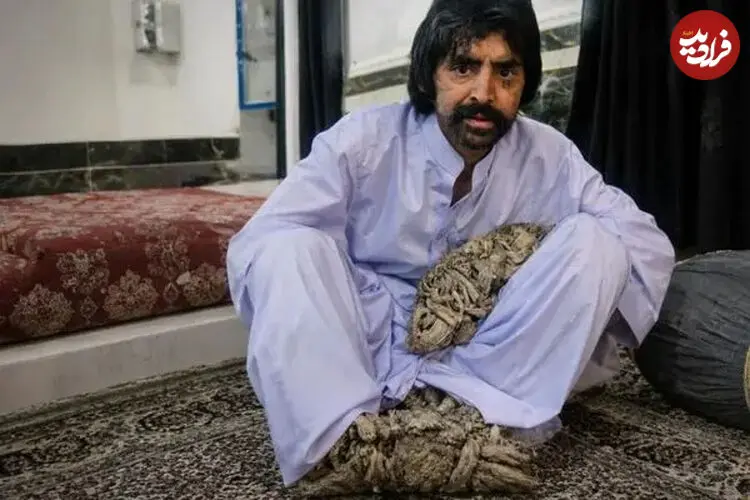 ببینید| مرد درختی برای درمان راهی آمریکا شد