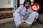 ببینید| مرد درختی برای درمان راهی آمریکا شد