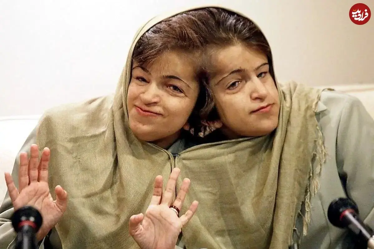 عکس| سفر در زمان؛ «لاله و لادن، دوقلوهای به هم چسبیده» در کودکی؛ دهه 50