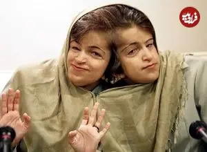 عکس| سفر در زمان؛ «لاله و لادن، دوقلوهای به هم چسبیده» در کودکی؛ دهه 50