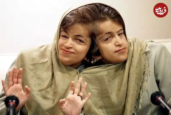 عکس| سفر در زمان؛ «لاله و لادن، دوقلوهای به هم چسبیده» در کودکی؛ دهه 50