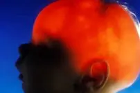 مورد عجیب الکس سیمپسون؛ نوزادی که تقریباً بدون مغز متولد شد، ۲۰ سالگی‌اش را جشن گرفت