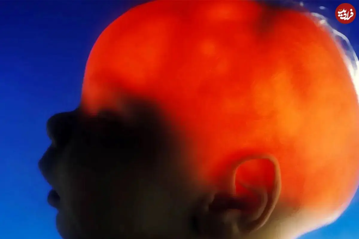 مورد عجیب الکس سیمپسون؛ نوزادی که تقریباً بدون مغز متولد شد، ۲۰ سالگی‌اش را جشن گرفت