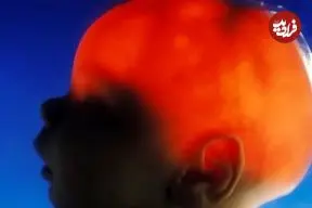 مورد عجیب الکس سیمپسون؛ نوزادی که تقریباً بدون مغز متولد شد، ۲۰ سالگی‌اش را جشن گرفت