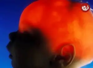 مورد عجیب الکس سیمپسون؛ نوزادی که تقریباً بدون مغز متولد شد، ۲۰ سالگی‌اش را جشن گرفت