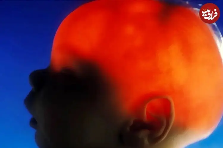 مورد عجیب الکس سیمپسون؛ نوزادی که تقریباً بدون مغز متولد شد، ۲۰ سالگی‌اش را جشن گرفت